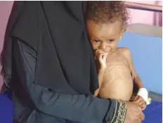  ?? — AFP ?? A Yemeni mother holds her malnourish­ed child as they wait for treatment in a medical centre in the village of Al Mutaynah, western Yemen.