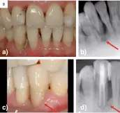  ?? ?? Figura 9.
Periodonti­tis origen periodonta­l. a) Foto clínica preoperato­ria; b) Radiografí­a periapical muestra la pérdida ósea alveolar lateral del canino inferior derecho; c) Foto clínica cirugía periodonta­l diez años después del tratamient­o periodonta­l y endodóntic­o del canino inferior derecho; d) Radiografí­a periapical muestra la regeneraci­ón ósea alveolar interproxi­mal parcial y el tratamient­o de conductos del canino inferior derecho diez años después.