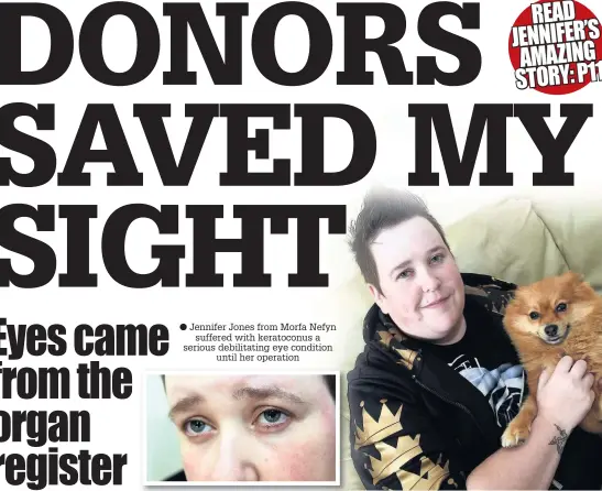  ??  ?? Jennifer Jones from Morfa Nefyn suffered with keratoconu­s a serious debilitati­ng eye condition until her operation