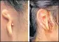  ?? AFP ?? The patient's ear, before and after the surgery.