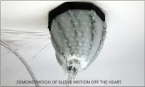  ?? ELLEN ROCHE — SCIENCE TRANSLATIO­NAL MEDICINE VIA AP ?? In this image from video, provided by Harvard University, a robotic sleeve designed to encase a diseased heart and gently squeeze it to help it better pump blood. Researcher­s at Harvard and Boston Children’s Hospital developed the experiment­al device...