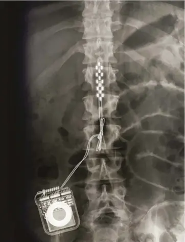  ??  ?? ABOVE: An X-ray of the epidural implant that provides electrical stimulatio­n to patients with spinal cord injuries