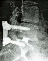  ??  ?? Above An X-ray showing the metalwork in Lewisohn’s spine following lumbar-fusion surgery