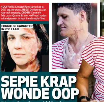  ??  ?? HOOFFOTO: Christel Rawstorne het in 2017 erg verbrand. REGS: Die letsels aan haar nek en gesig. ONDER: Connie in 7de Laan (Quinne Brown Huffman) nadat ’n handgranaa­t in haar hand ontplof het. CONNIE SE KARAKTER IN 7DE LAAN