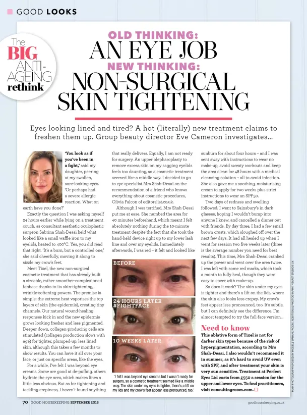  ??  ?? ‘I felt I was beyond eye creams but I wasn’t ready for surgery, so a cosmetic treatment seemed like a middle way. The skin under my eyes is tighter, there’s a lift on my lids and my crow’s feet appear less pronounced, too.’