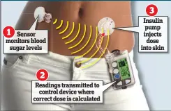  ??  ?? HOW THE DEVICE WORKS Insulin pump injects dose into skin Readings transmitte­d to control device where correct dose is calculated Sensor monitors blood sugar levels