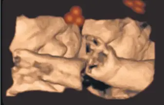  ?? LANCASTER UNIVERSITY ?? A 4- D ultrasound of a fetus tracks a stimulus during research into fetal cognition. The ultrasound scans often show the fetuses blinking their eyes.