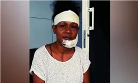  ??  ?? Debbie Kaore, an internatio­nal rugby player and boxer, has shared an image of herself after being allegedly beaten with an iron by her partner in a domestic attack. Photograph: Debbie Kaore