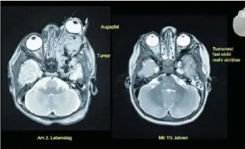  ??  ?? MRI-Bilder zeigen den Tumor vor (l.) und nach der Behandlung (r.) mit dem Medikament.