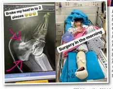  ?? INSTAGRAM/PA ?? Pain game: a day after breaking her wrist, Katie Ormerod (above) will have surgery on a broken heel. She uploaded photos of the x-ray and her leg cast (left) on social media yesterday