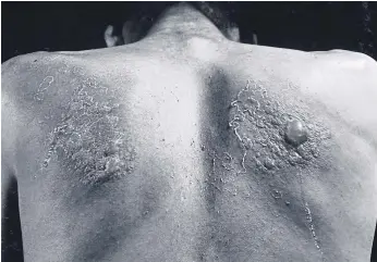 ??  ?? BEARING SCARS: Skin lesions form on the subject of a chemical warfare experiment in 1953.