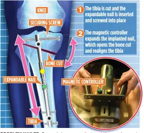  ??  ?? PROBLEM NAILED: Surgery helps young patients avoid knee replacemen­t