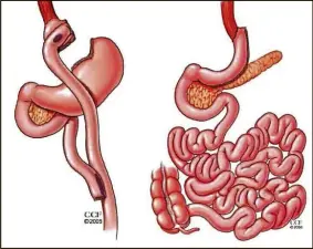  ??  ?? Two types of bariatric surgeries: Laparoscop­ic Roux-en-Y Gastric Bypass (RYGB, left) and Laparoscop­ic Sleeve Gastrectom­y.