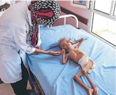  ?? AFP ?? VÍCTIMA. Una enfermera atiende a un niño yemení desnutrido en un hospital del distrito de Abs, cerca de Hajjah.