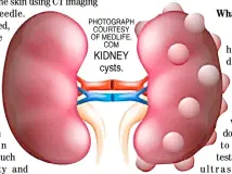  ??  ?? PHOTOGRAPH COURTESY OF MEDLIFE. COM KIDNEY cysts.