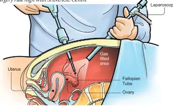  ??  ?? Laparoscop­e Gas filled area Uterus Fallopian Tube Ovary