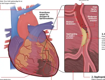  ??  ?? 1. Kransårer
Dette er tre arterier som forsyner hjertet med blod. De er helt nødvendige for at hjertet skal fungere effektivt.
Hjertemusk­el 5. Dødt vev
Enkelte deler av hjertemusk­elen kan dø av mangel på oksygen. Dette gjør muskelen blir mindre...