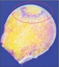  ?? Yale Medicine / Contribute­d photo ?? An image of a femoral head (the ball at the top of the femur) showing where a region of the blood supply has suffered from vascular necrosis.
