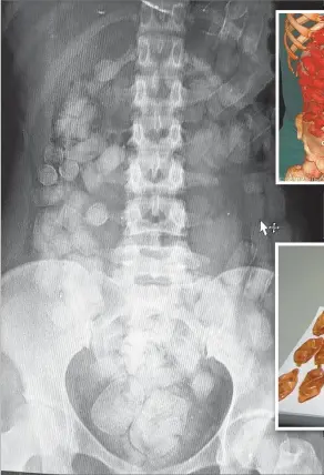  ?? CEDOC PERFIL ?? Cocaína sólida Es el método más tradiciona­l. Dependiend­o la persona pueden llevar más de 100 cápsulas con droga. En caso de estallar, la mula muere a las pocas horas por sobredosis.