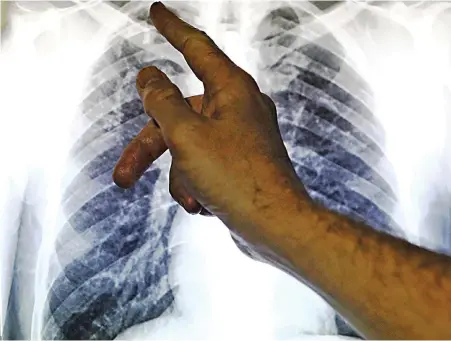  ?? PICTURE: REUTERS ?? KILLER: An X-ray of lungs infected with TB. About 270 people in the country die of the disease daily.