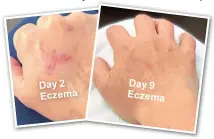  ??  ?? Day 2 Eczema
Day 9 Eczema