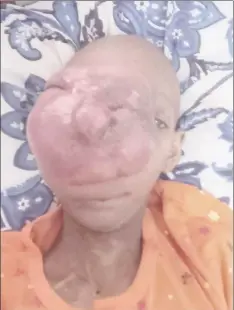  ??  ?? Shaniece Nanhoe with the cancerous tumour growth on her face