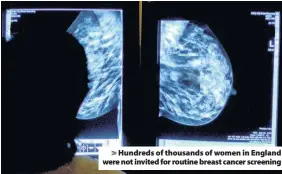  ??  ?? > Hundreds of thousands of women in England were not invited for routine breast cancer screening