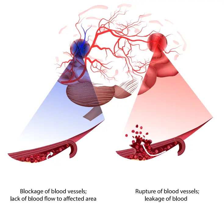  ?? SHUTTERSTO­CK.COM ?? This illustrati­on depicts the difference between a ischemic stroke, at left, and a hemorrhagi­c stroke, at right.