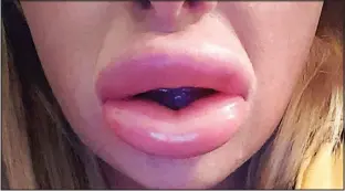  ??  ?? Ouch! Leona Omalley’s swollen mouth following the injection by a beautician