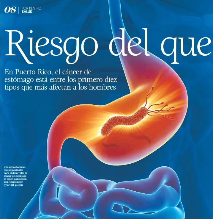  ??  ?? Uno de los factores más importante­s para el desarrollo de cáncer de estómago es tener la infección con Helicobact­er pylori (H. pylori).