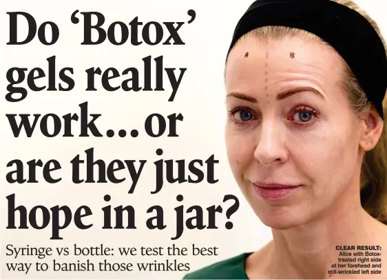  ??  ?? CLEAR RESULT: Alice with Botoxtreat­ed right side of her forehead and still-wrinkled left side