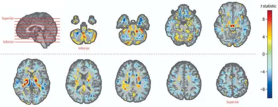  ?? Photo / AP ?? The scans by the American Medical Associatio­n shows the amount of difference­s between patients, diplomats and a control group.