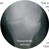  ??  ?? Osteoarthr­itis on X-ray.