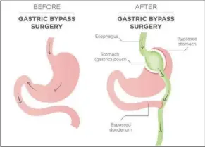  ?? — Photos: Handout ?? In a gastric bypass, surgeons are aiming to both reduce the amount of calories the patient can eat, as well as the amount of nutrients they can absorb from their food.