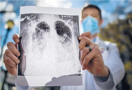  ?? MARK MIRKO/HARTFORD COURANT PHOTOS ?? Dr. Sam Pope, a pulmonary critical care physician and director of the medical ICU at Hartford Hospital, holds a printed X-ray illustrati­ng double-lung pneumonia typical in COVID-19 patients.
