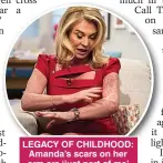  ??  ?? LEGACY OF CHILDHOOD: Amanda’s scars on her arm are ‘just part of me’