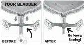  ??  ?? AFTER
No More Peeing!
“Stopping bladder leaks is like turning off a faucet,” says Dr. Stephen Klayman. “Your ‘faucet’ is this little pipe known as your bladder’s Sphincter Valve. It controls your flow of urine. Strengthen­ing the muscle around it, your literally turns off this valve so you can’t leak – exactly what this pill is formulated to do.”