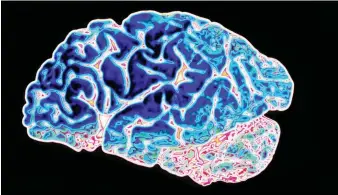  ??  ?? This computer-enhanced image shows a brain with Alzheimer’s. The widened areas between the folds are caused by wasting of the brain tissue – a classic physical symptom of the disease