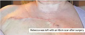  ?? ?? Rebecca was left with an 18cm scar after surgery