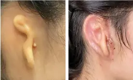  ?? ?? The patient’s ear before and after the procedure. Photograph: Microtia-Congenital Ear Institute and 3DBio Therapeuti­cs