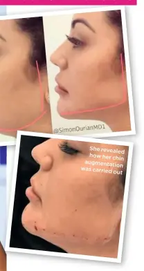  ??  ?? She revealed how her chin augmenta tion was carried out