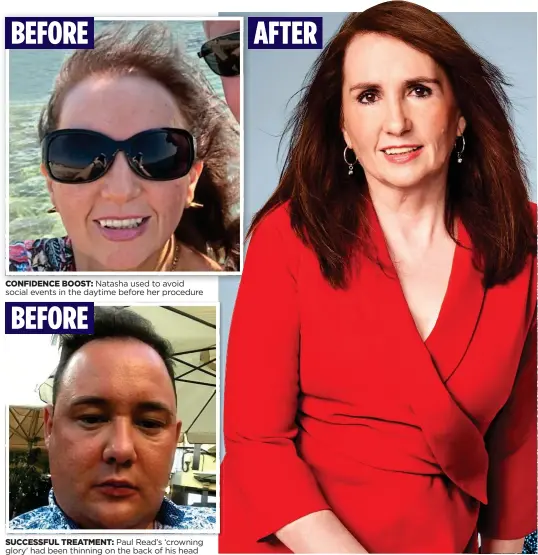  ??  ?? CONFIDENCE BOOST: Natasha used to avoid social events in the daytime before her procedure
SUCCESSFUL TREATMENT: Paul Read’s ‘crowning glory’ had been thinning on the back of his head