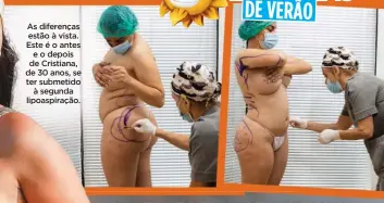  ??  ?? As diferenças estão à vista. Este é o antes e o depois de Cristiana, de 30 anos, se ter submetido à segunda lipoaspira­ção.