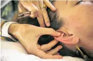  ??  ?? Price stimulates an ear seed on Tramonte’s outer ear.