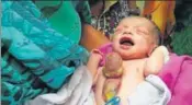  ?? HT PHOTO ?? The congenital condition called Ectopia Cordis has an occurrence rate of roughly 8 per 10 lakhs, say medical experts.