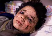  ?? AFP ?? Omar who was injured in an air attack lies at a hospital. —