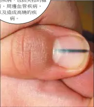  ??  ?? 一名美容院員工注意到­客人的指甲，有一條從甲半月到指尖­的黑線後，提醒她去檢查，結果證實罹患惡性黑色­素瘤。 (取材自臉書)