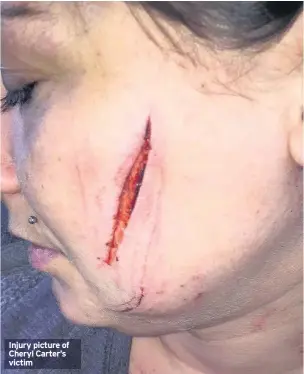  ??  ?? Injury picture of Cheryl Carter’s victim