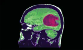  ?? Photograph: BSIP/Universal Images Group/Getty Images ?? An X-ray shows a type of glioma, an umbrella term for the most common brain tumor in cancer patients.