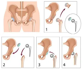  ?? COURTESY OF AUSTRALIAN GOVERNMENT DEPARTMENT OF HEALTH AND AGED CARE ?? An illustrati­on of how a hip joint is replaced. During total hip replacemen­t surgery, the damaged bone and cartilage are removed from the hip joint. These are replaced with metal or plastic parts.